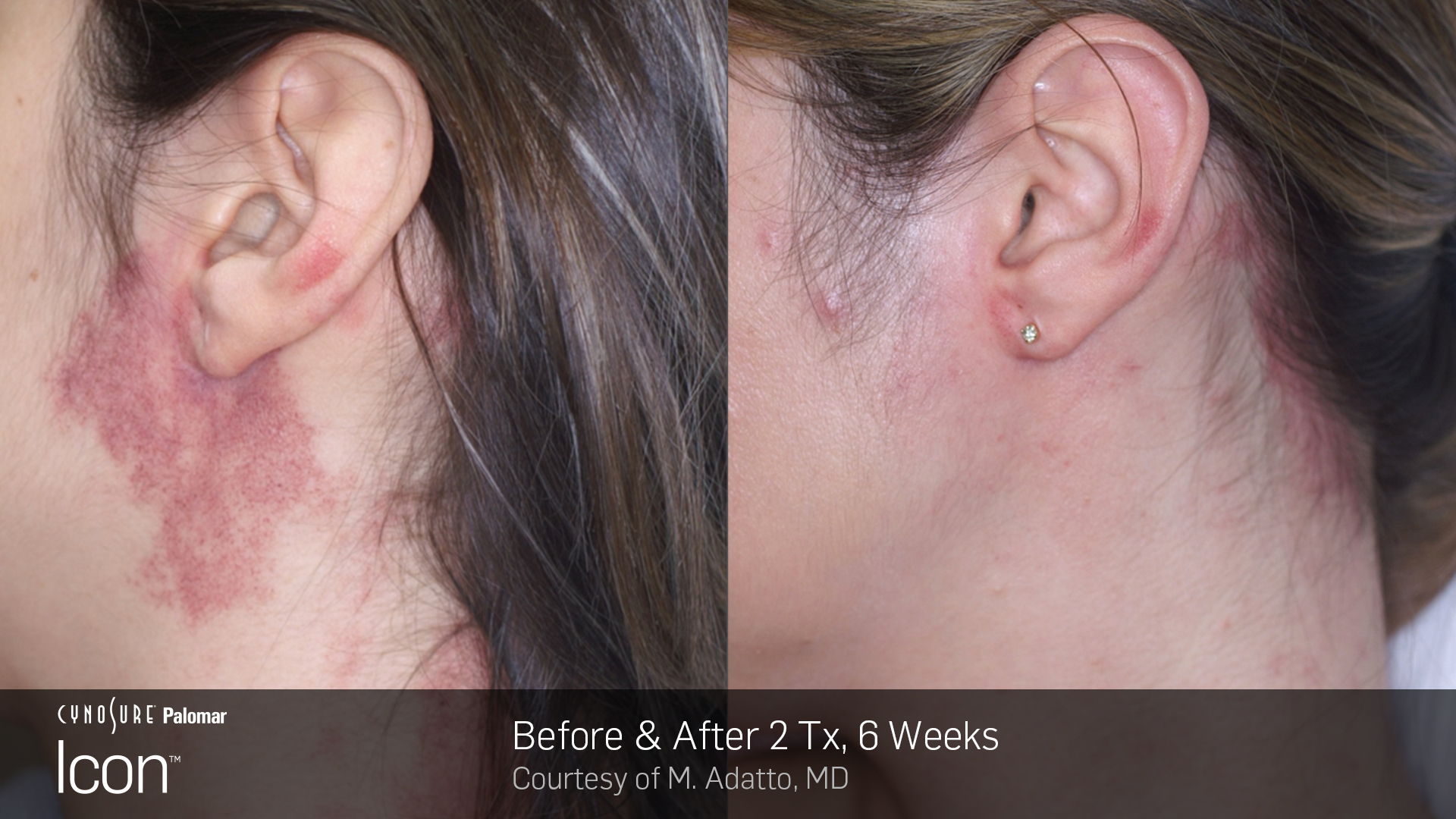 Before and After results of IPL-1 Treatment in Delray Beach by Dash Medical Spa