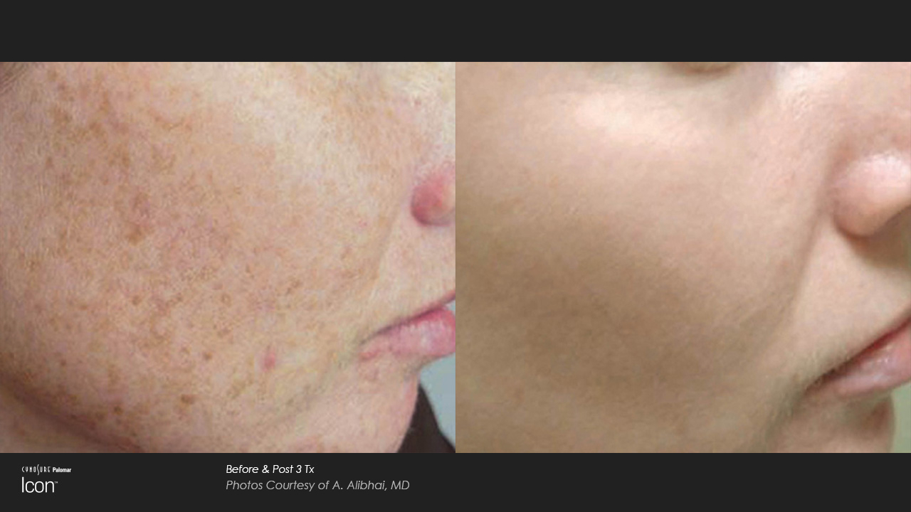 Before and After results of IPL-2 Treatment in Delray Beach by Dash Medical Spa