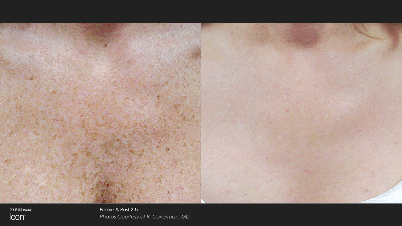 Before and After results of IPL-3 Treatment in Delray Beach by Dash Medical Spa