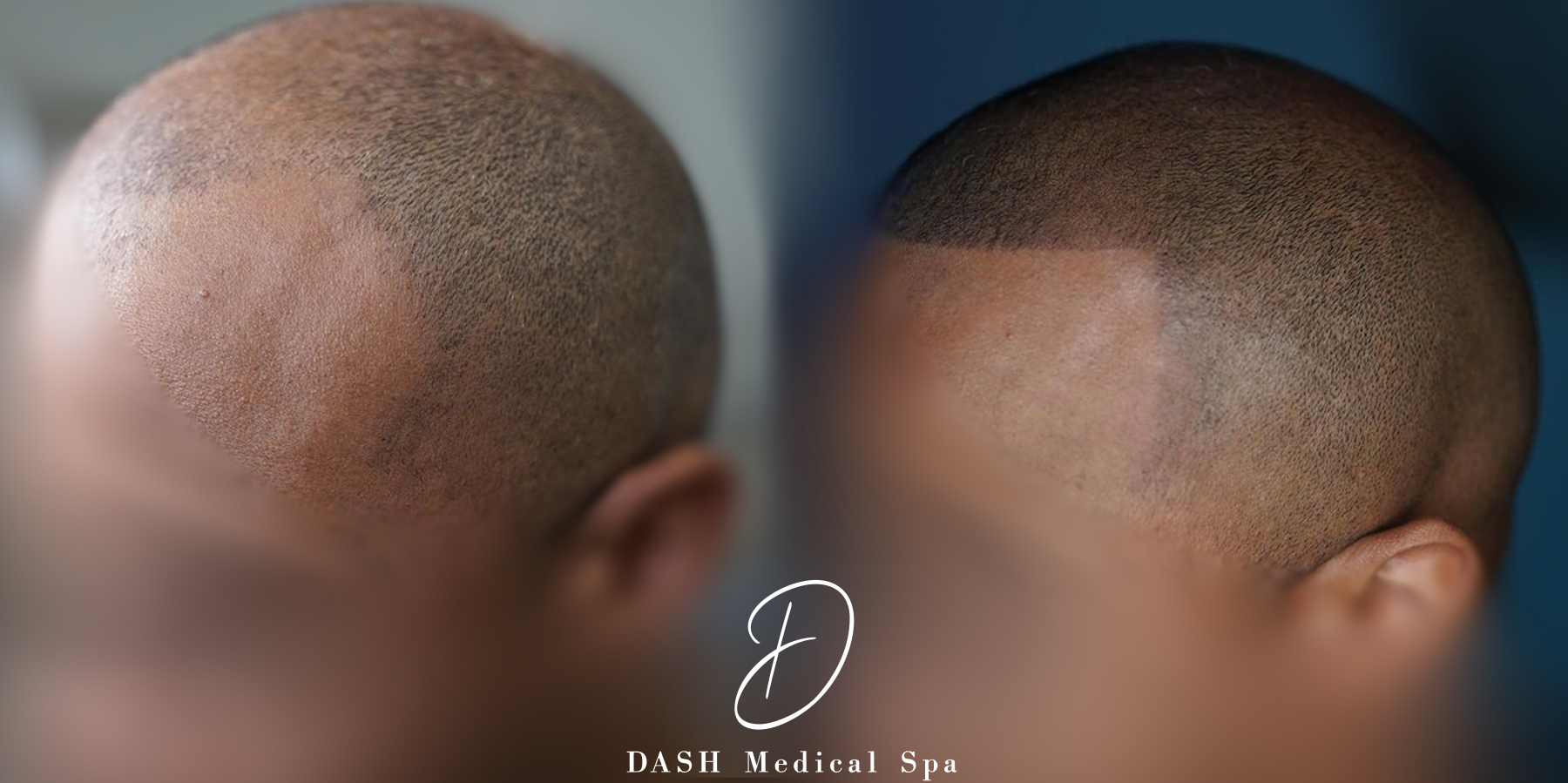 Before and After results of Scalp Micropigmentation Treatment in Delray Beach by Dash Medical Spa