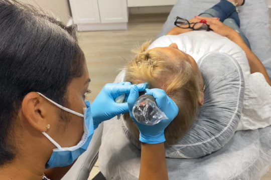 Scalp Micropigmentation Treatment in Delray Beach by Dash Medical Spa