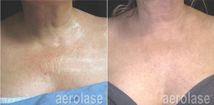 Before and After results of Neoskin Treatment in Delray Beach by Dash Medical Spa