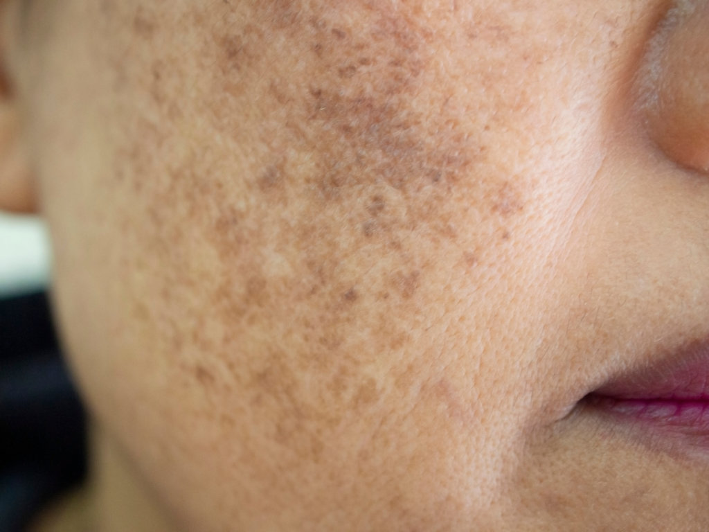 Melasma Treatment in Delray Beach, FL