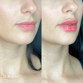 Before and After results of Restylane Kysse Treatment in Delray Beach by Dash Medical Spa