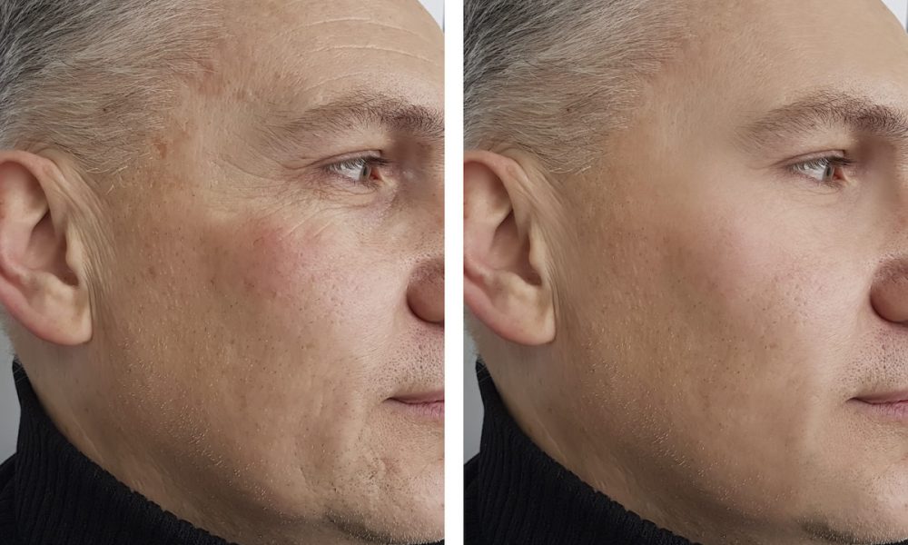 Before and After results of Longer Lasting Botox Treatment in Delray Beach by Dash Medical Spa