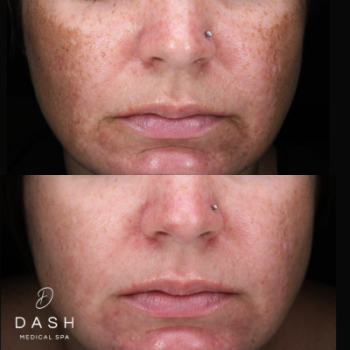 Before and After results of Melasma Laser Skin Resurfacing Treatment in Delray Beach by Dash Medical Spa