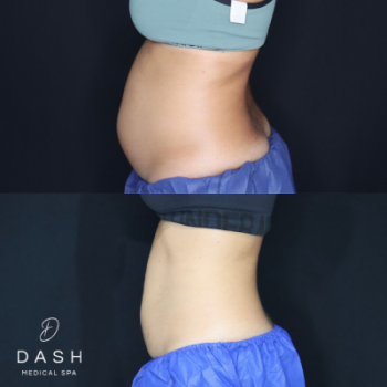 Before and After results of coolsculpting treatment in Delray Beach by Dash Medical Spa
