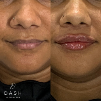 Before and After results of Lip filler Treatment in Delray Beach by Dash Medical Spa