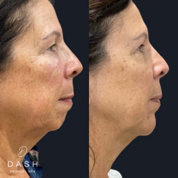Before and After results of Chin Filler Treatment in Delray Beach by Dash Medical Spa