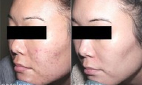 acne_acne scars