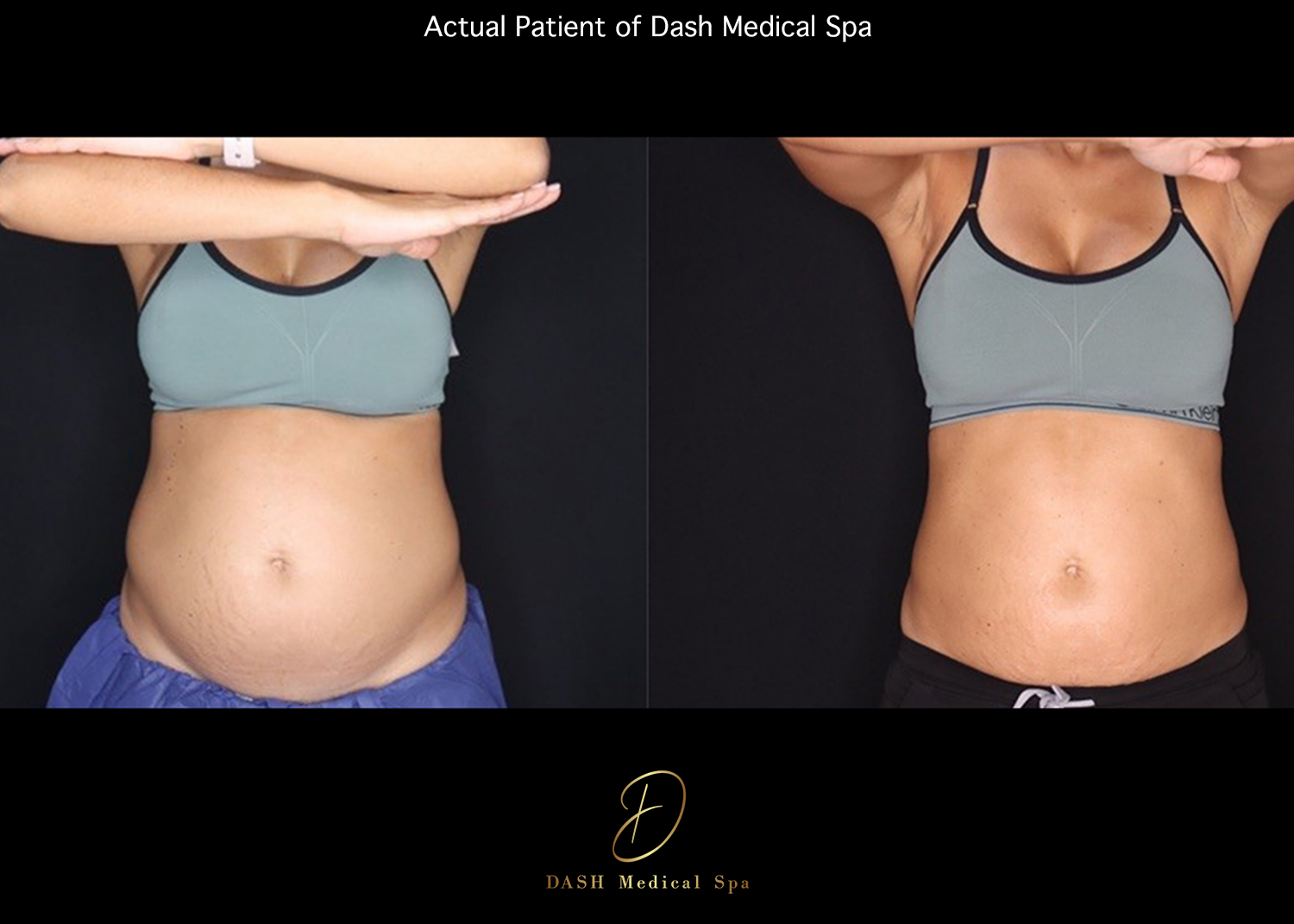 Before and After results of coolsculpting treatment in Delray Beach by Dash Medical Spa