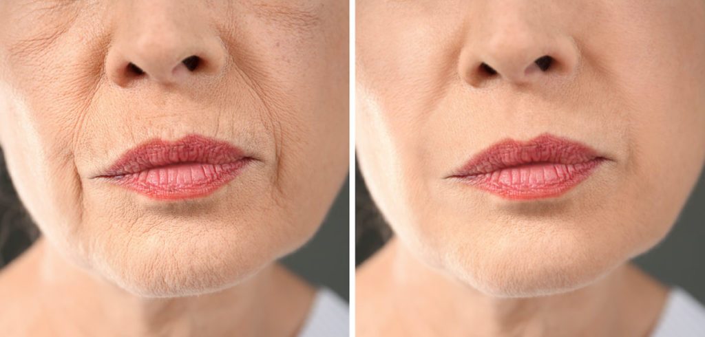 Before and After results of Dermal Fillers Treatment in Delray Beach by Dash Medical Spa