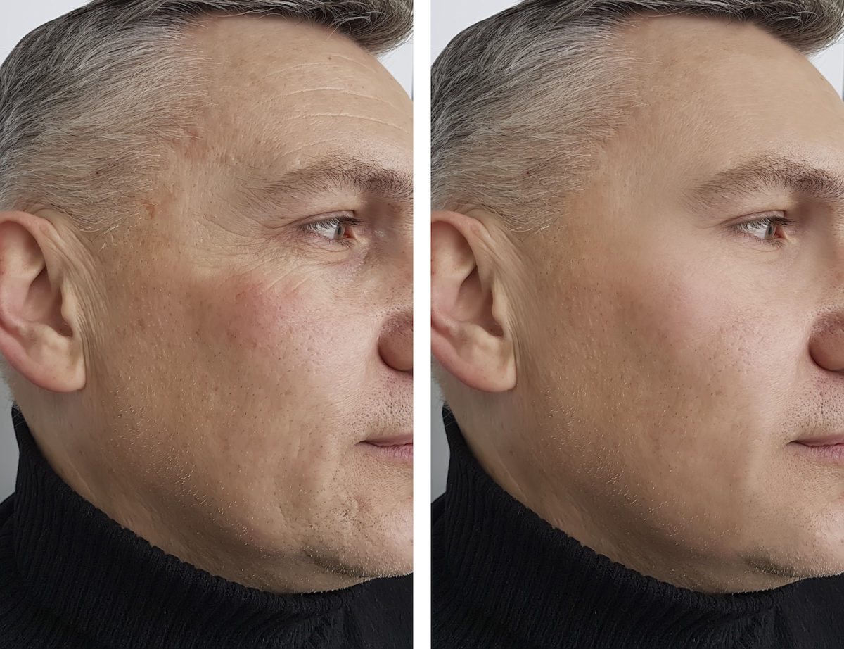 Before and After results of Longer Lasting Botox Treatment in Delray Beach by Dash Medical Spa