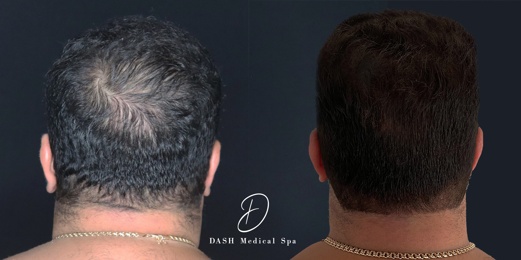 Before and After results of Scalp Micropigmentation Treatment in Delray Beach by Dash Medical Spa
