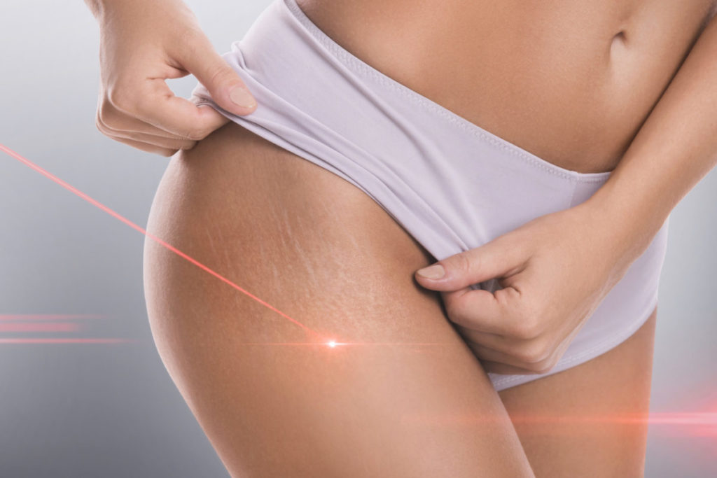 Stretch Mark Removal Treatment in Delray Beach by Dash Medical Spa