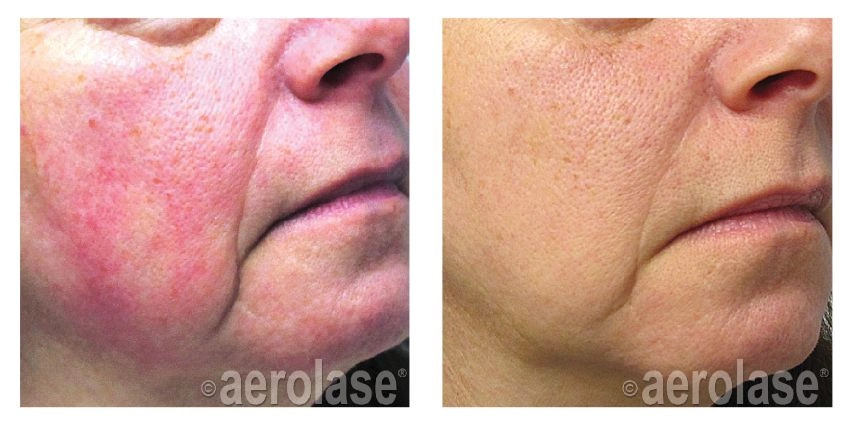 Before and After results of Neoskin Treatment in Delray Beach by Dash Medical Spa