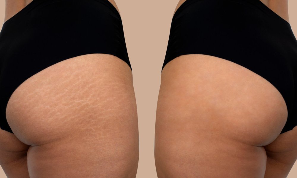 12 Best Treatments to Get Rid of Stretch Mark Removal