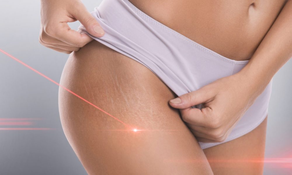 Stretch Mark Removal Treatment in Delray Beach by Dash Medical Spa