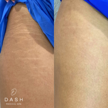 Before and After results of Laser Strech mark removal Treatment in Delray Beach by Dash Medical Spa