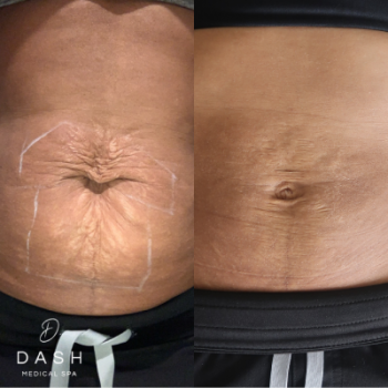 Before and After results of Strech mark removal treatment in Delray Beach by Dash Medical Spa