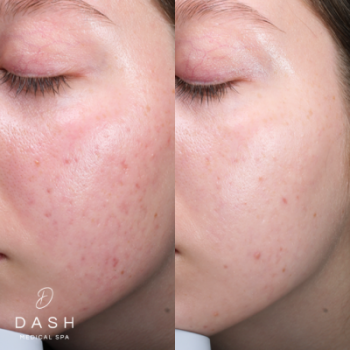Before and After results of Microneedling Treatment in Delray Beach by Dash Medical Spa